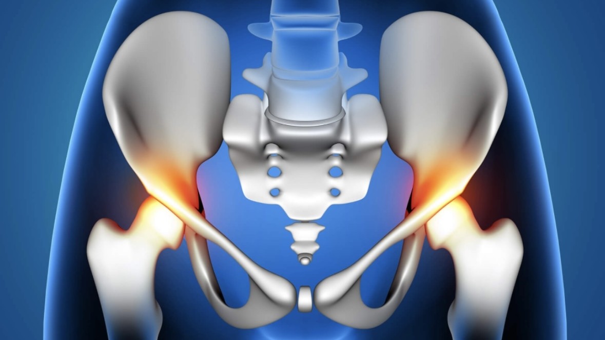 Αρθροπλαστική Ισχίου