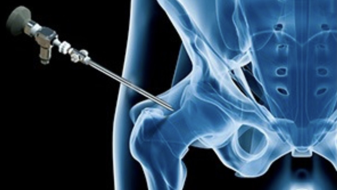 Αρθροσκόπηση Ισχίου