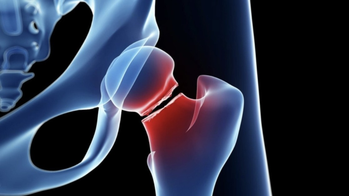 Κάταγμα Ισχίου