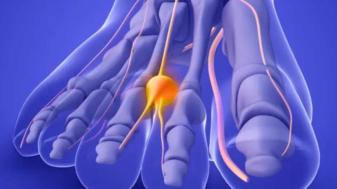 Νεύρωμα Morton