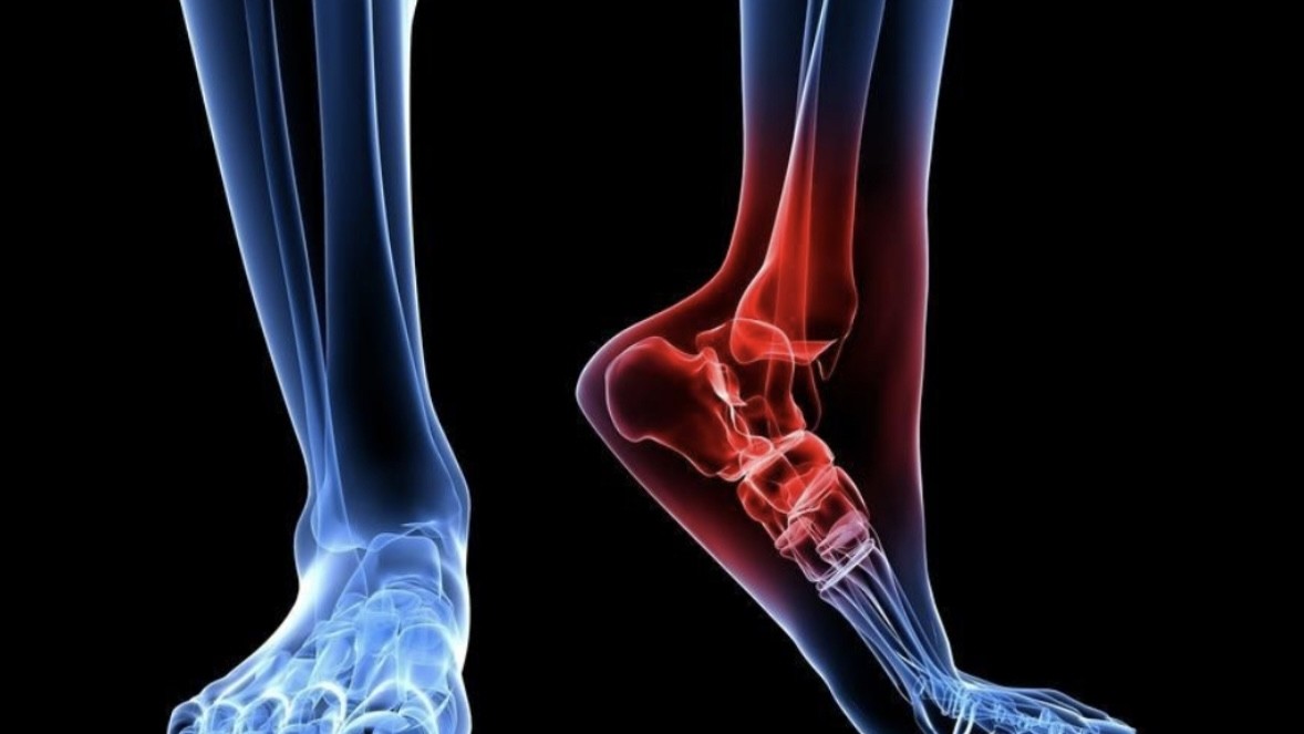 Ρήξη αχίλλειου τένοντα