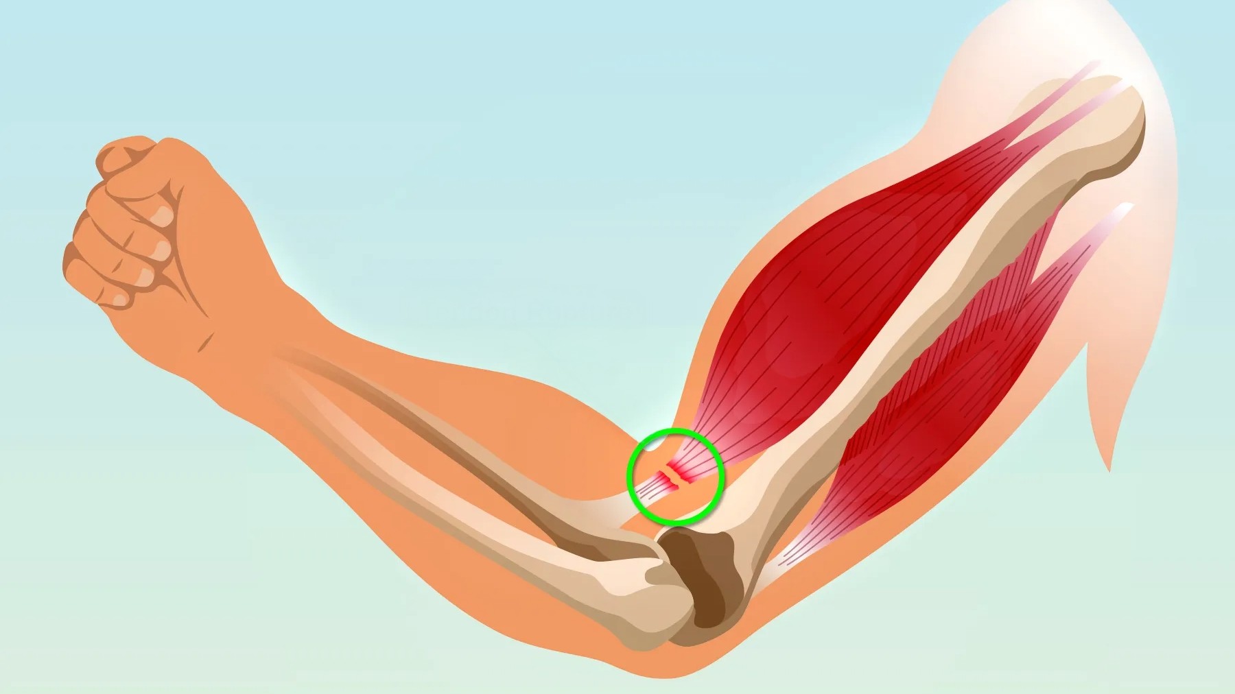 Ρήξη Τένοντα Δικεφάλου 