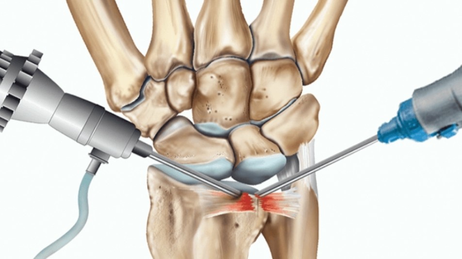 Αρθροσκόπηση Καρπού